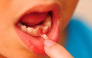 脫落的乳牙通常都擁有豐富的干細胞-不要丟掉-