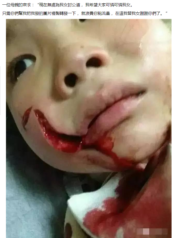 被 狗咬傷的女孩 ~狗主人卻是而不見-警察說這部歸他們管