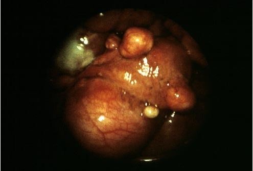 什麼樣的女人容易得 子宫肌瘤 ?