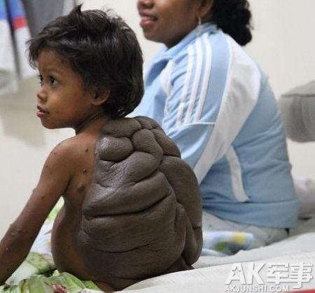 8歲男孩背上長出巨大烏龜殼!