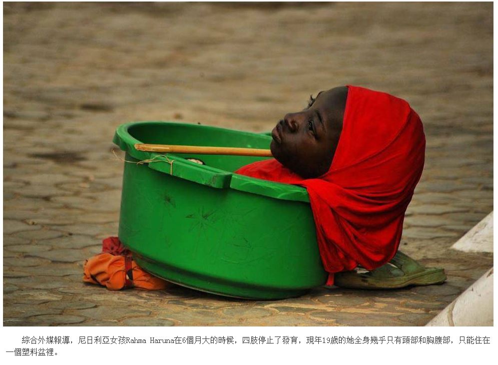 尼日利亞女孩患怪病全身只剩頭部一生住在盆裡