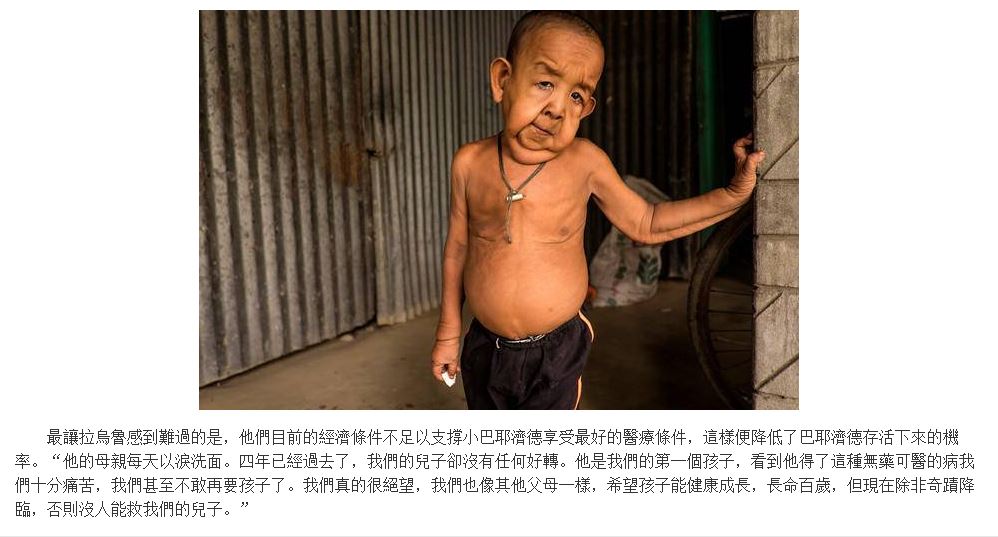 現實版”返老還童”：孟加拉四歲男孩面容宛如老翁