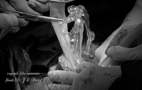 腹中胎兒揮手似求救 醫師奇蹟救回罕見病例