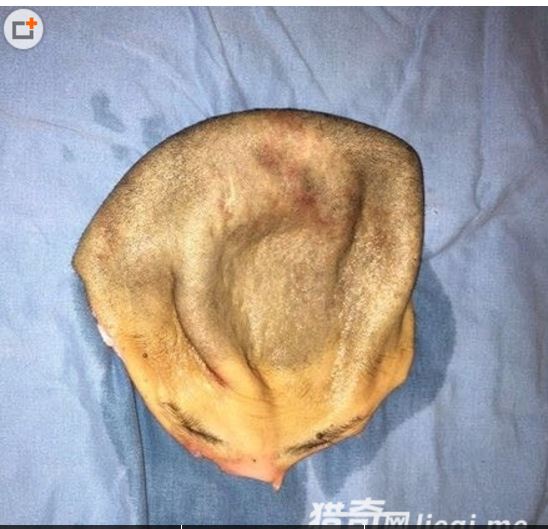 女子頭皮被機器撕下，醫生14小時縫回